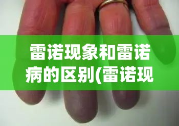 雷诺现象和雷诺病的区别(雷诺现象和雷诺综合征的区别) 雷诺现象和雷诺病的区别(雷诺现象和雷诺综合征的区别)