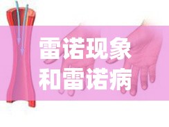 雷诺现象和雷诺病的区别(雷诺现象和雷诺综合征的区别) 雷诺现象和雷诺病的区别(雷诺现象和雷诺综合征的区别)