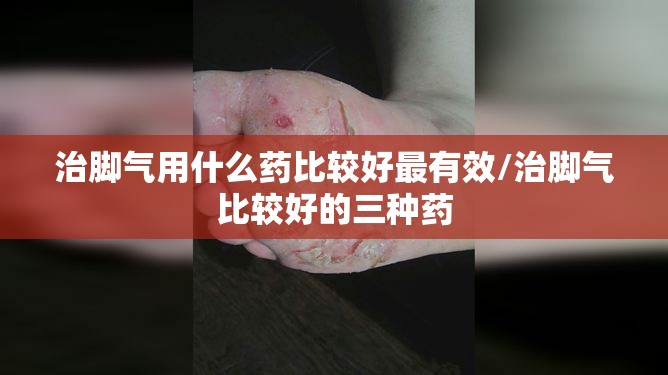 治脚气用什么药比较好最有效/治脚气比较好的三种药 治脚气用什么药比较好最有效/治脚气比较好的三种药